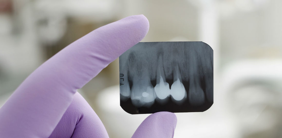 Рентген-снимок зубов